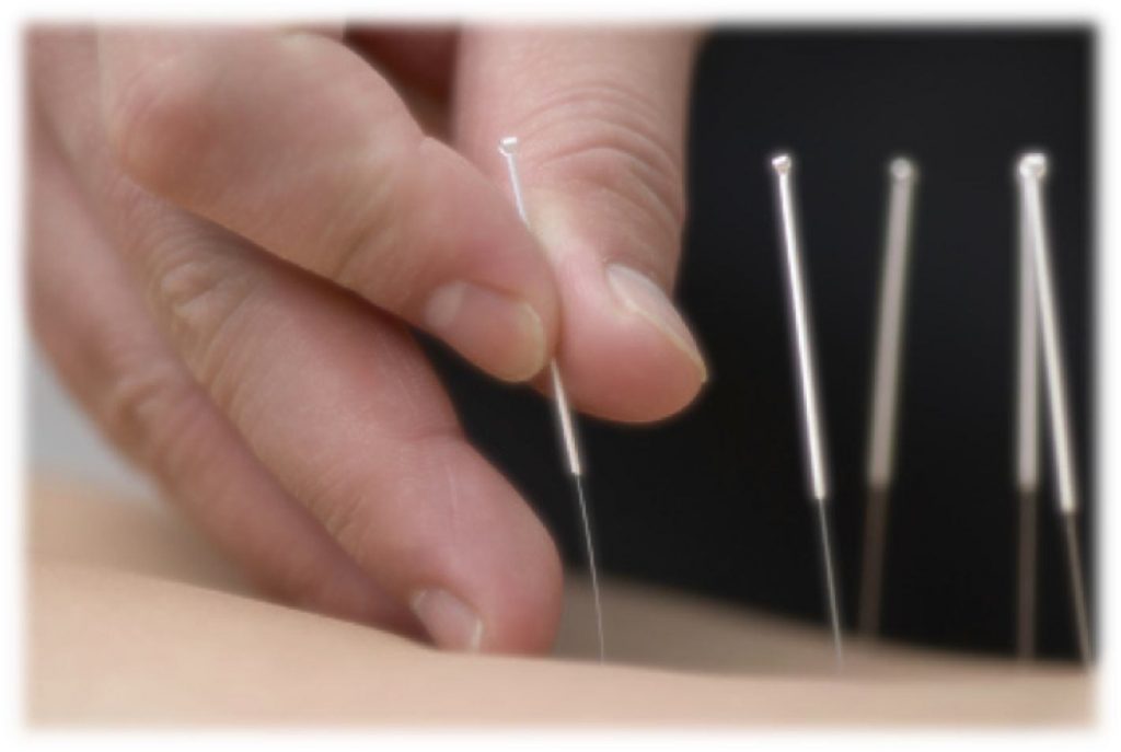Acupuntura na Apneia do Sono
