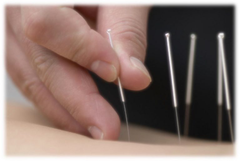 Acupuntura na Apneia do Sono